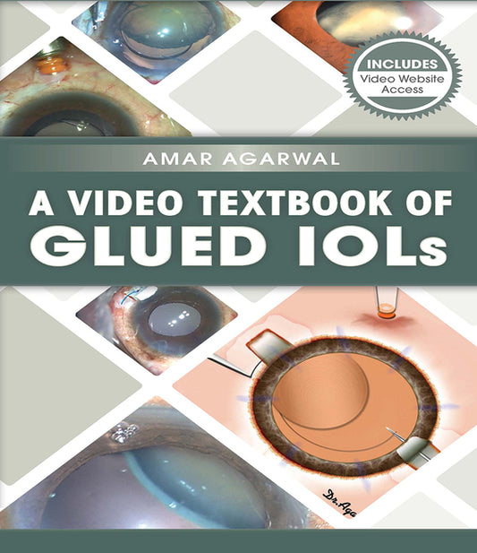 Video Textbook of Glued IOLs - Ingram